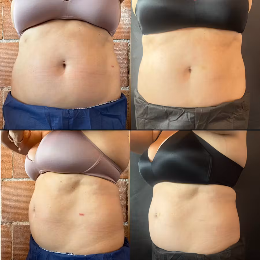 Before and after comparison showing abdominal fat reduction from weight loss treatment results