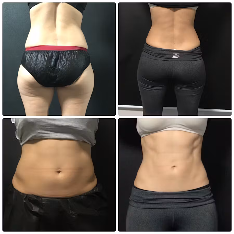 Before and after comparison showing waist and abdominal contour changes following weight loss treatment