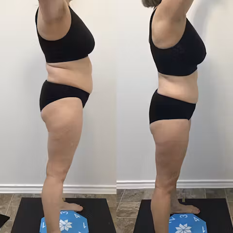 Before and after side view comparison showing reduced body fat and improved overall body contour