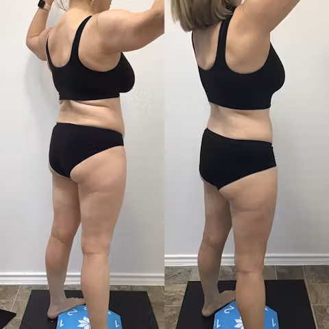 Before and after comparison showing body contour and weight loss results in a woman wearing black underwear