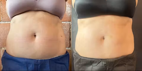 Before and after comparison showing reduced abdominal fat and improved waist contour