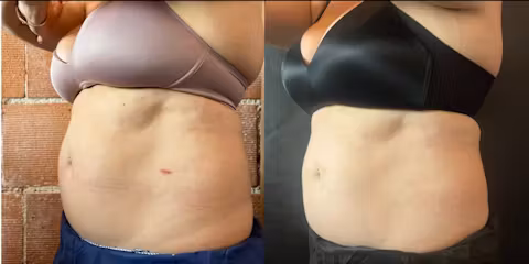 Before and after comparison showing abdominal fat reduction and improved waist contour