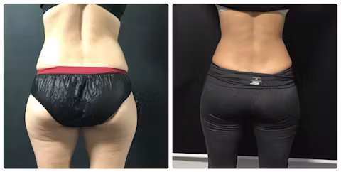 Before and after comparison showing body contour and weight loss results in a woman wearing black underwear