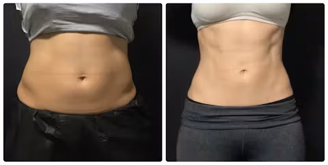 Before and after comparison showing reduced abdominal fat and improved waist definition
