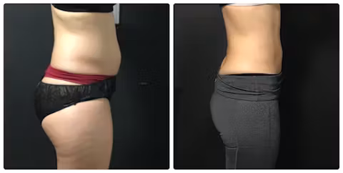 Before and after side view comparison showing reduced abdominal and waist fullness