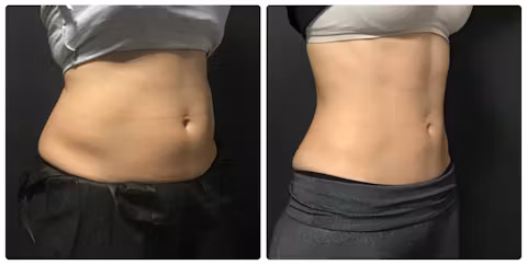 Before and after comparison showing reduced abdominal fat and improved waist definition