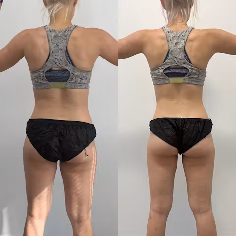 Before and after comparison showing overall body slimming and improved waist definition