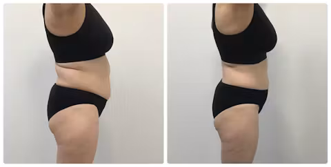 Before and after side view comparison showing reduced waist and abdominal contour