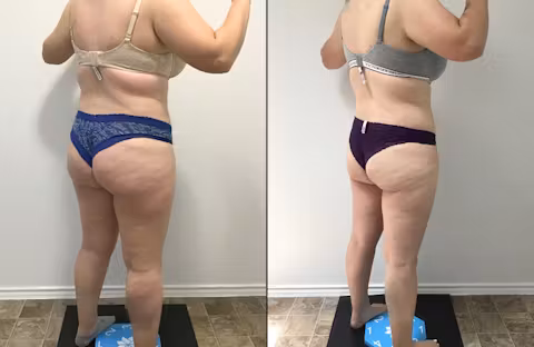 Before and after back view comparison showing reduced body fat and improved lower body contour