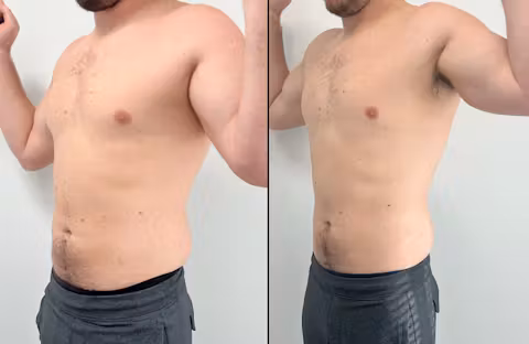 Before and after comparison showing reduced abdominal fat and improved upper body definition in a man