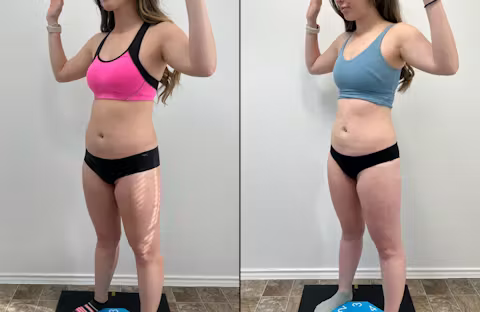 Before and after comparison showing reduced body fat and improved body contour in a woman wearing athletic clothing