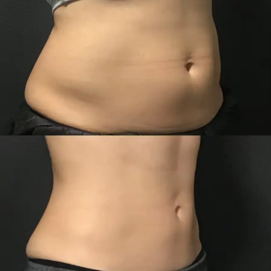 Before and after side view comparison showing reduction in abdominal fullness after weight loss treatment